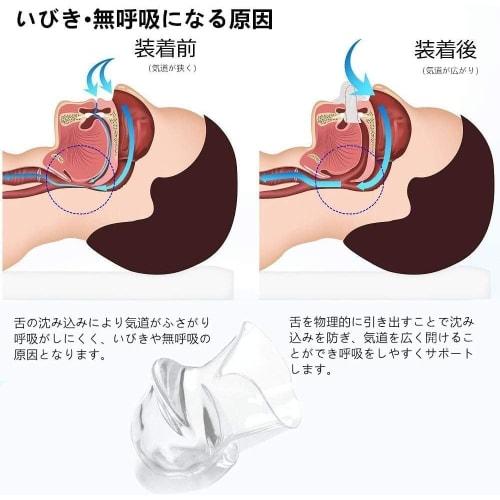 Snoring Mouthpiece, Anti-Snoring Aid, Tongue Mouthpiece, Snoring Prevention Aid, Prevents Snoring, Reduces Sleep Noise, Mouth Breathing, Includes Stor