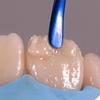 GDC Titanium Coated Composite Anterior Placing (Tncipcm)