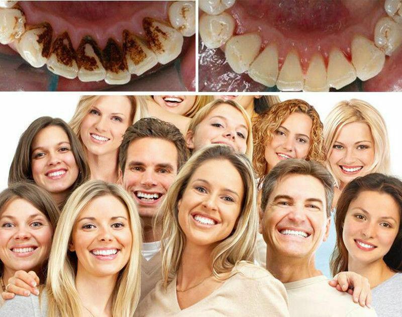 Dental Ultrasonic Tartar Remover Electric Ultrasonic Piezo Scaler