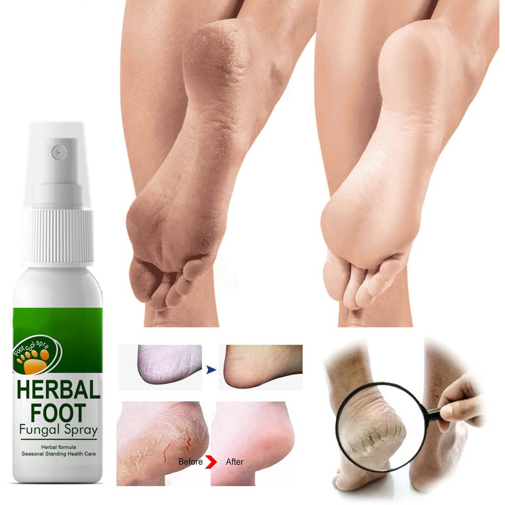 30 мл травяной спрей для ног, пот ног, запах ног, спрей, снимающий зуд, спрей для ухода за ногами от запаха пилинга