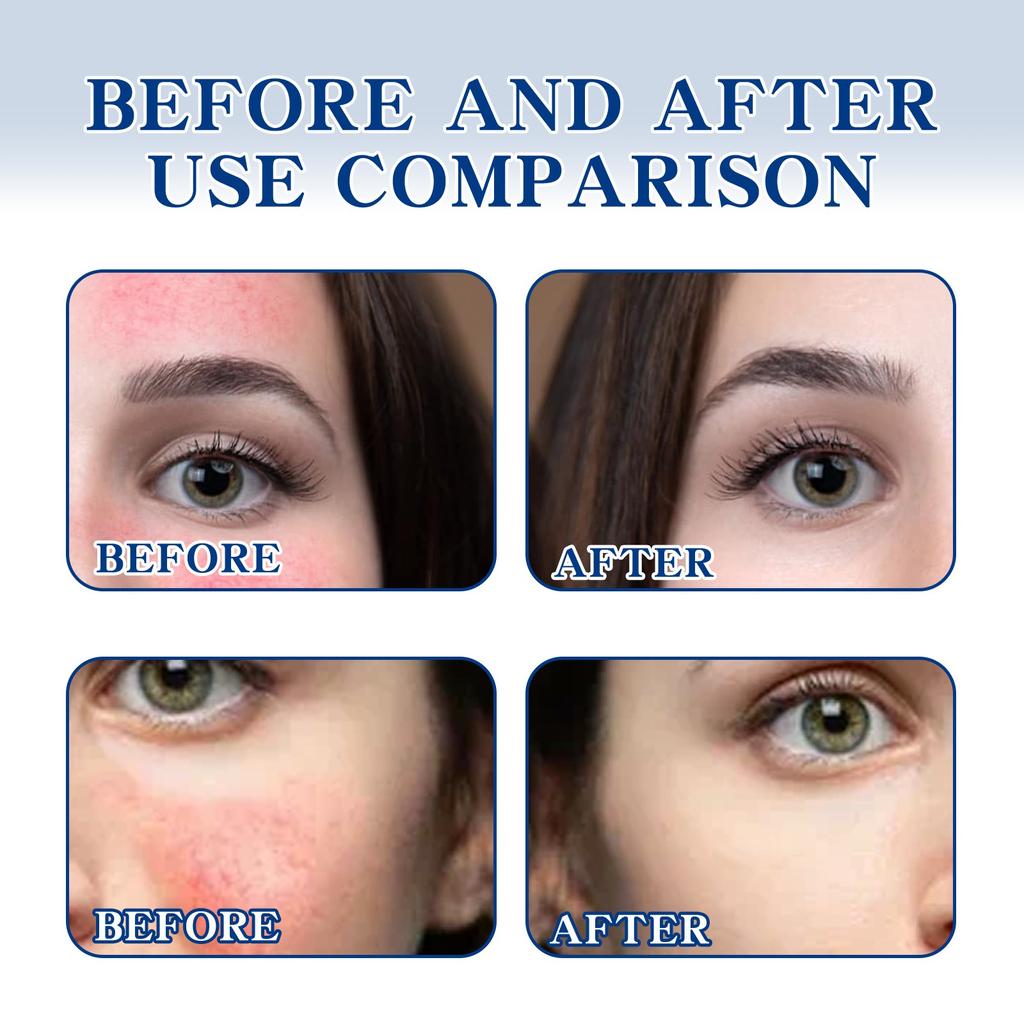 Паста для лица от розацеа, коллагеновая паста, покраснение, сухая, чувствительная, зуд, кожа, увлажняющая, успокаивающая.