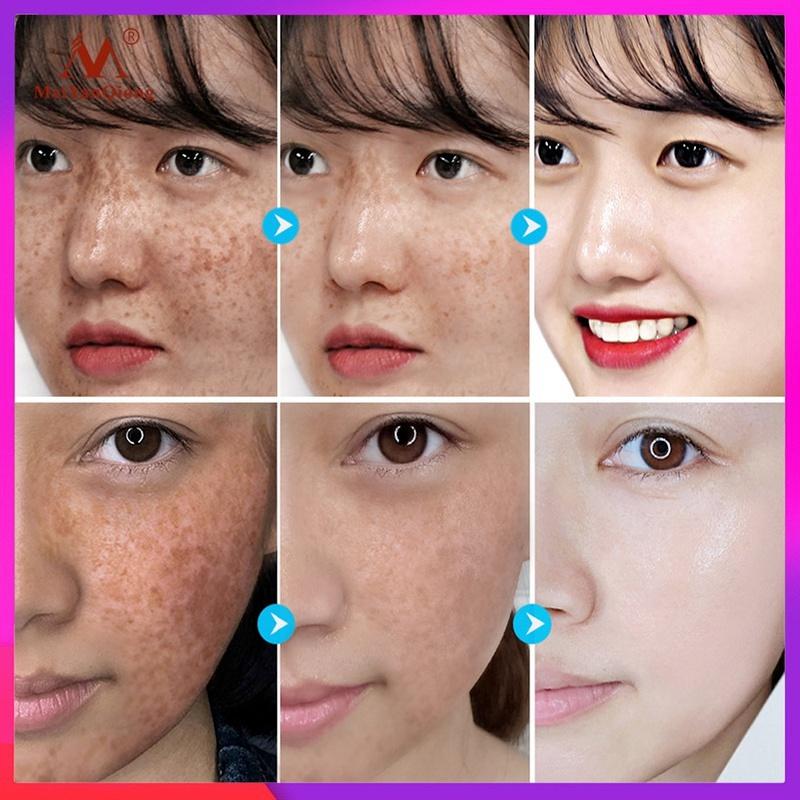 Новейший крем-корректор темных пятен, отбеливающий крем для лица, ремонт, выцветание веснушек, удаление темных пятен, средство для удаления меланина, осветляющий крем для лица