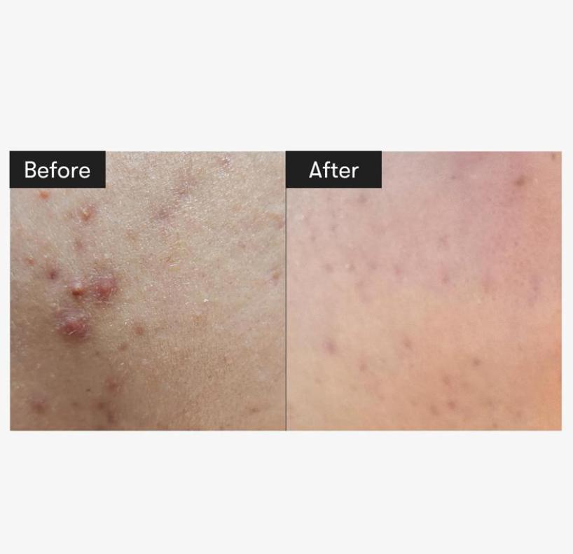 VT Reedle Shot 100 Эссенция 50 мл | Мягкий микроигольный уход за кожей для ежедневного использования