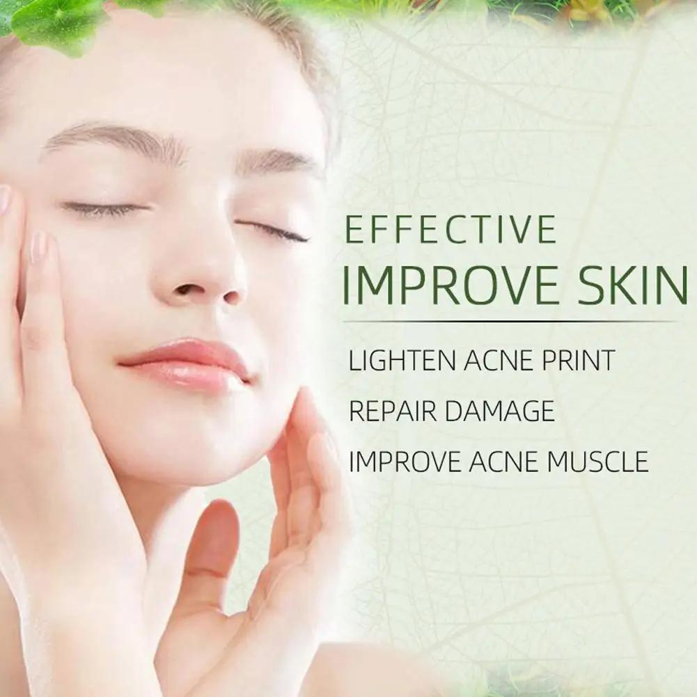 Крем для лица от прыщей, устранение больших пор, лечение прыщей, контроль жирности, сужение пор, крем для лица, уход за кожей, красота, здоровье
