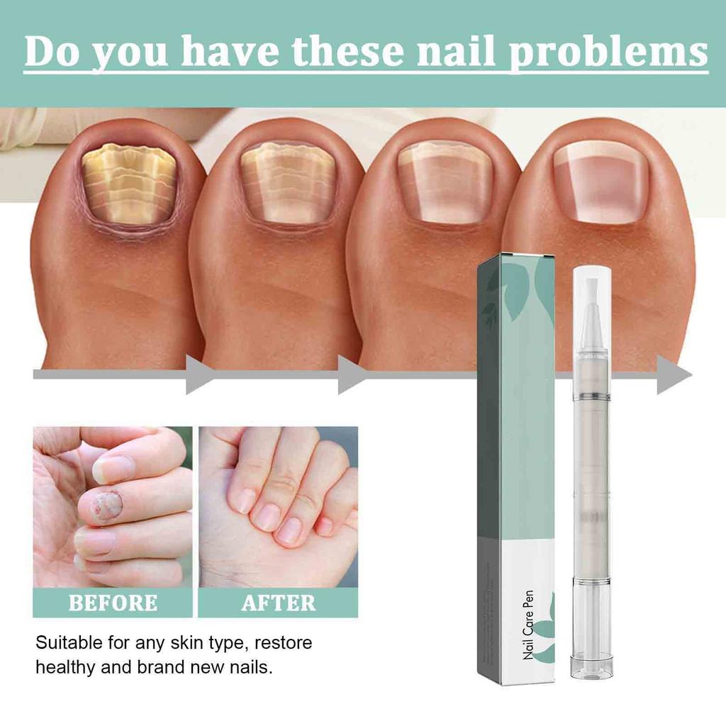 Nail TreatmentPen, Nail Cuticle Oil, Damaged Nail Pen, Nail Strengthening CuticleSwitch, AloeVera And TeaTree Oil RepairDamaged,3ml
