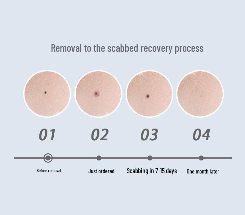 Лазерная ручка Aurora LCD для удаления родинок и веснушек - Косметический прибор для домашнего использования