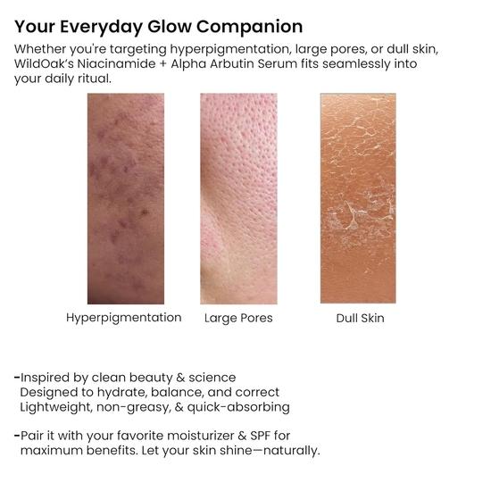 WILD OAK 2% Alpha Arbutin + 10% Niacinamide Face Serum | Alpha Arbutin Is Powerful For Pigmentation, Acne Scars & Spot | 30Ml