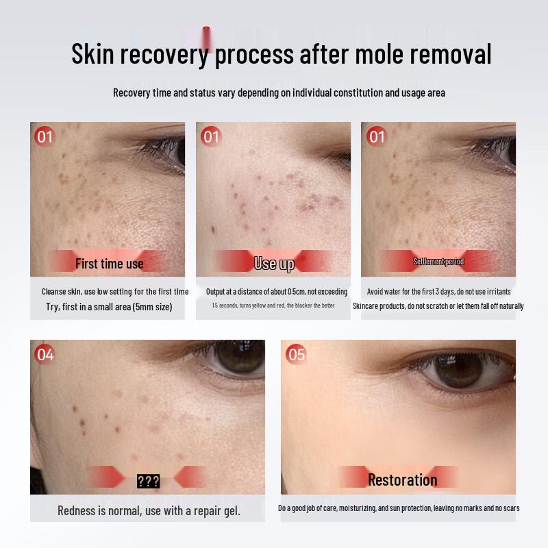 Picosecond Laser Spot & Tattoo Removal Device