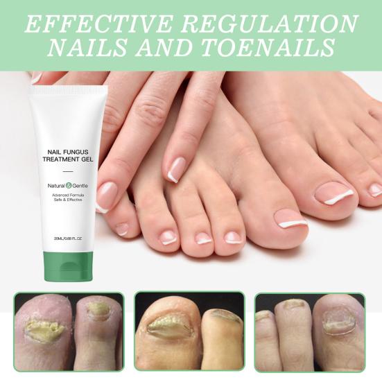 1/2Pcs 20ML Nail Fungus Treatment Gel Natural Ingredients Portable Men Women Hydrating Moisturizing Multi-Purpose Nail Repair Care Gel