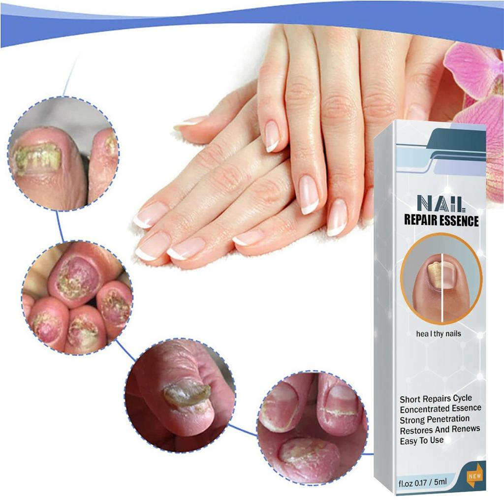 Exstroyeza Pen FUNGAL NAIL PEN Масло для ногтей 5 мл