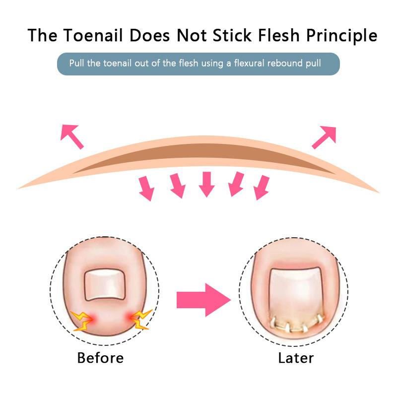 Инструменты для коррекции вросших ногтей на ногах, восстановление педикюра, лечение ногтей на ногах, профессиональная коррекция вросших ногтей, инструмент для ухода за ногами