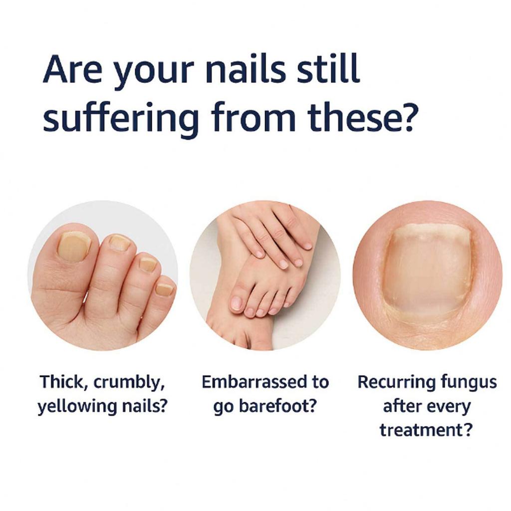 Ручка для ногтей на ногах Трещина ногтя, Раствор для ухода за вросшим ногтем, Мягкий ноготь, Серая ручка 4 мл