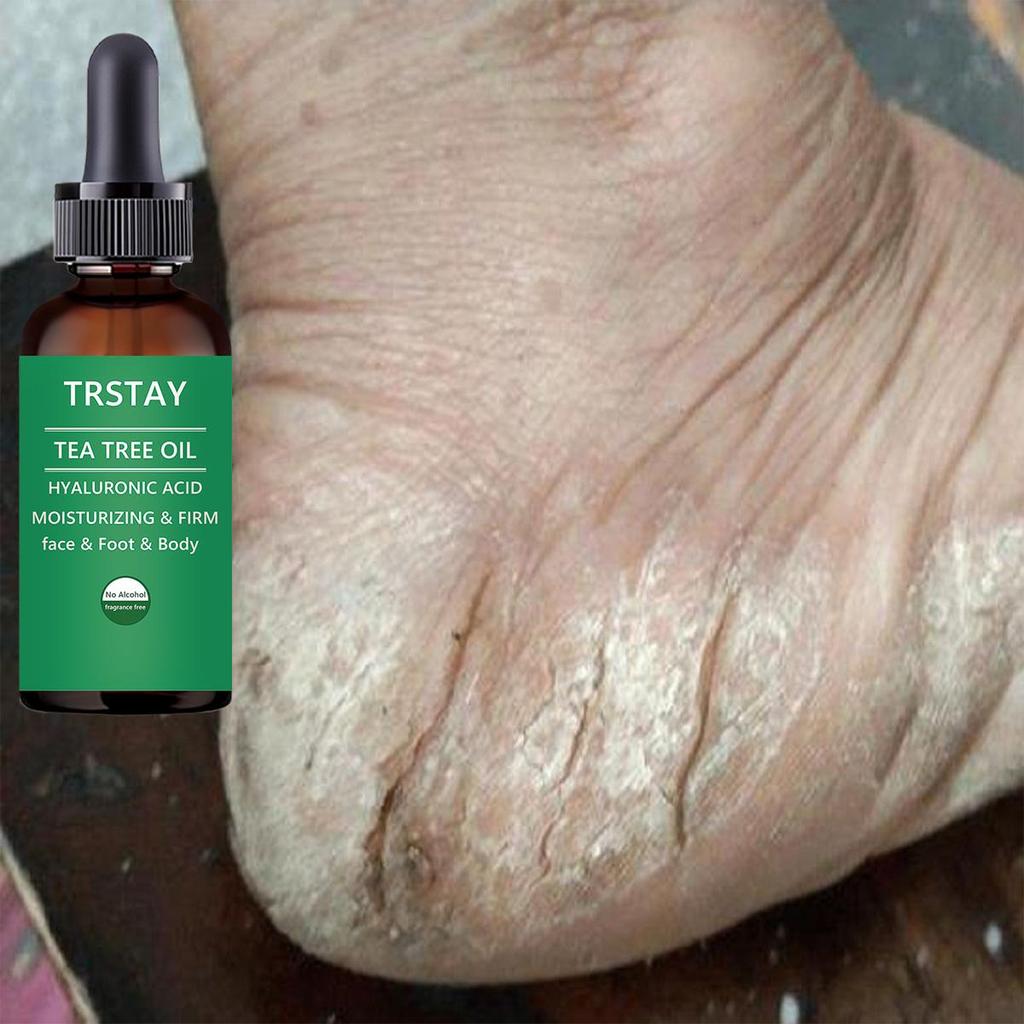 Лечение ног: Растительный лосьон для ног, увлажняющая эссенция для ухода за ногами для сухой кожи, потрескавшихся пяток, сильная целебная сила, противогрибковое средство