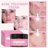 Удалить прыщи, мягкое восстановление, прыщи, следы от прыщей, питательный, увлажняющий, увлажняющий крем от прыщей