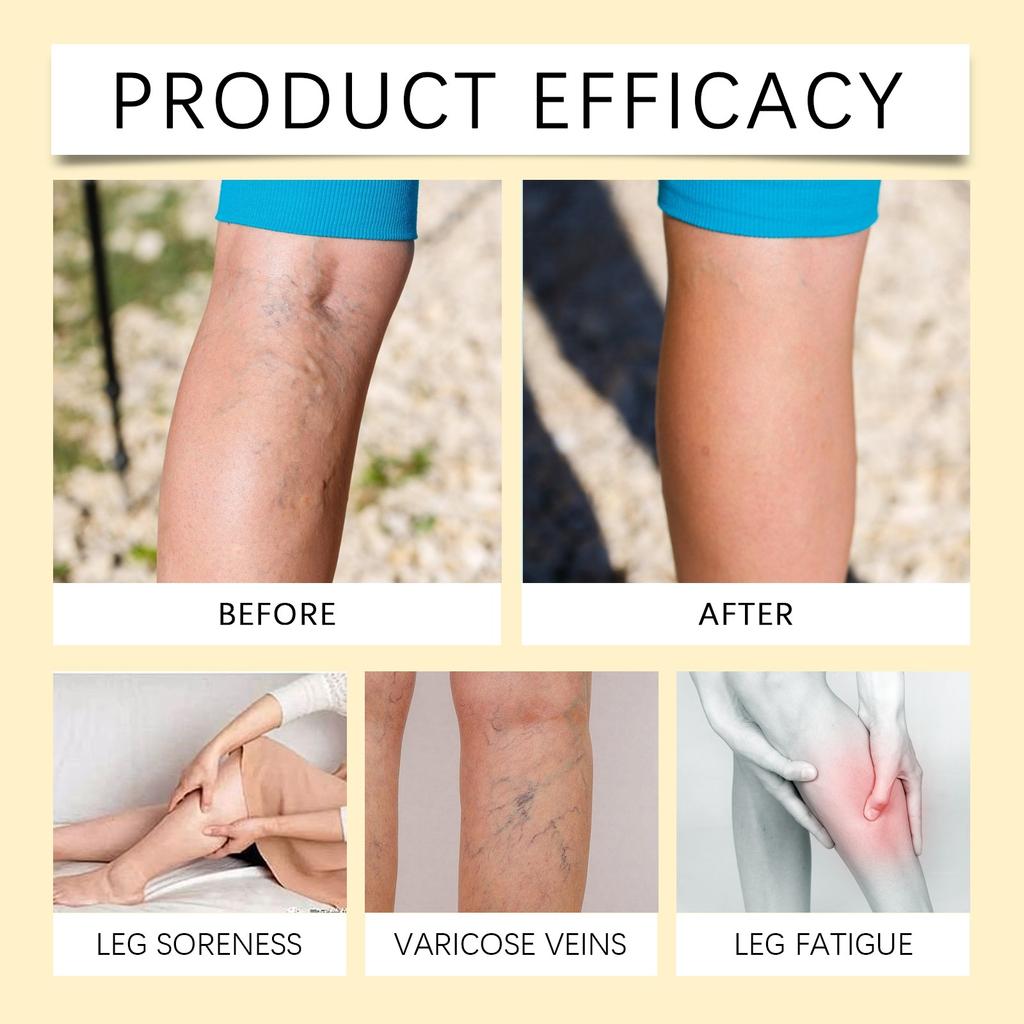 Крем для ухода за ногами на основе трав, массажный уход, синие вены, восстанавливает, снимает дискомфорт, крем для ухода за ногами