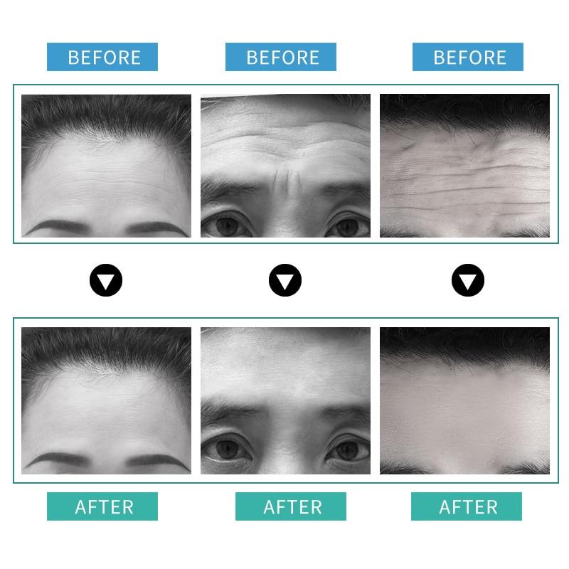 10Pcs/Box Forehead Line Removal Anti-wrinkle Stickers Frown Lines Treatment Anti-aging Lifting Mask Moisturizng Patch Skin Care Facial Pad