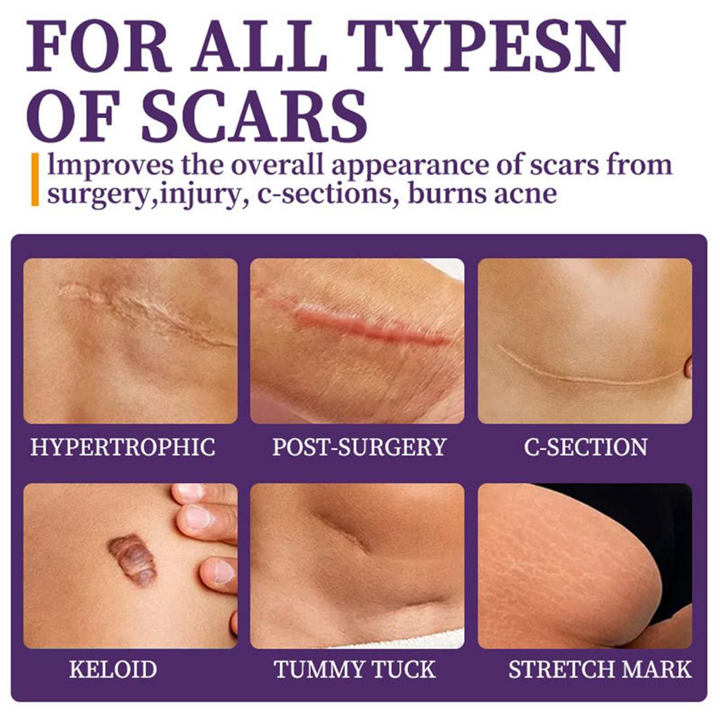 Крем от шрамов, ожогов, шрамов, шишек и геля для ухода за беременными, мягко осветляет