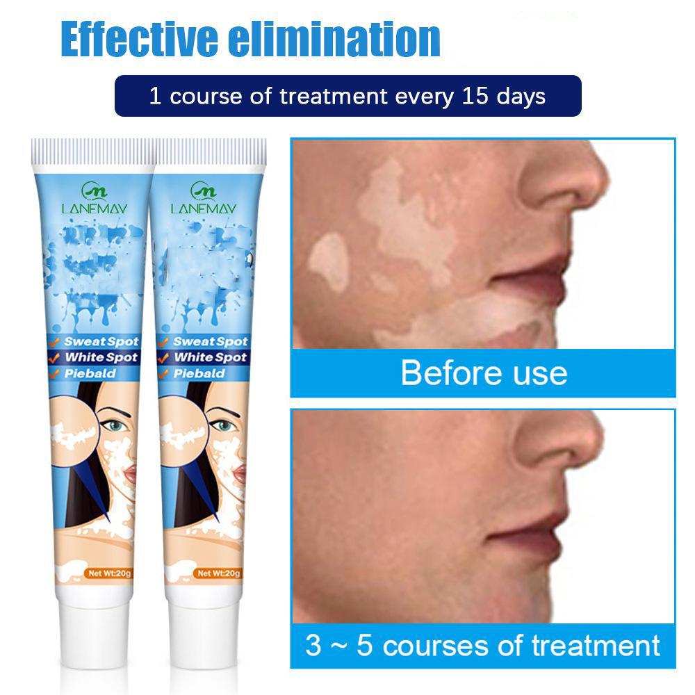 Кремы для лица Лосьоны Болезни Кремы и лосьоны для лица Кремы и лосьоны для лица Кремы и лосьоны для лица Болезни Крем от белых пятен 20г