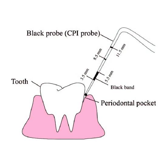 GDC Двусторонние зонды Cp12 / Скрининговый зонд №6 (Pcp12/11.5b)