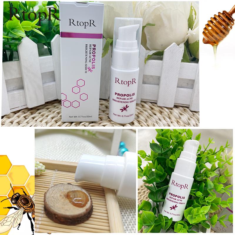 Прополис восстанавливает осветляющую сыворотку от прыщей, очищающую сыворотку от шрамов от прыщей, сужает поры, устраняет лечение прыщей, контроль жирности