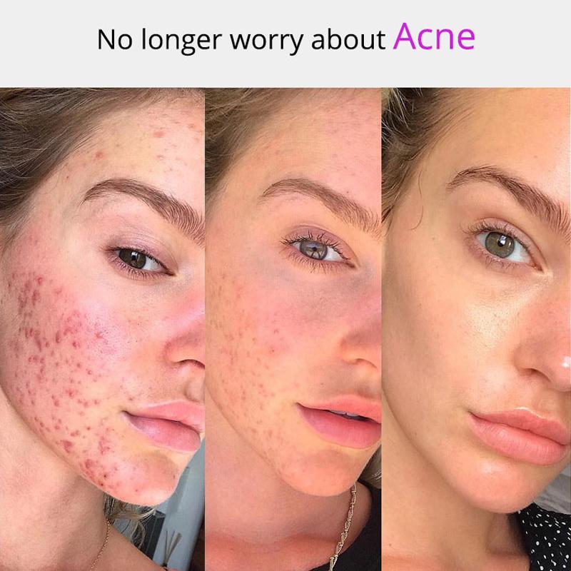 Высокочастотный аппарат для лица, аргон, фиолетовый свет, средство для удаления прыщей, воспаления, массажер для ухода за кожей лица, Красота, спа-палочка