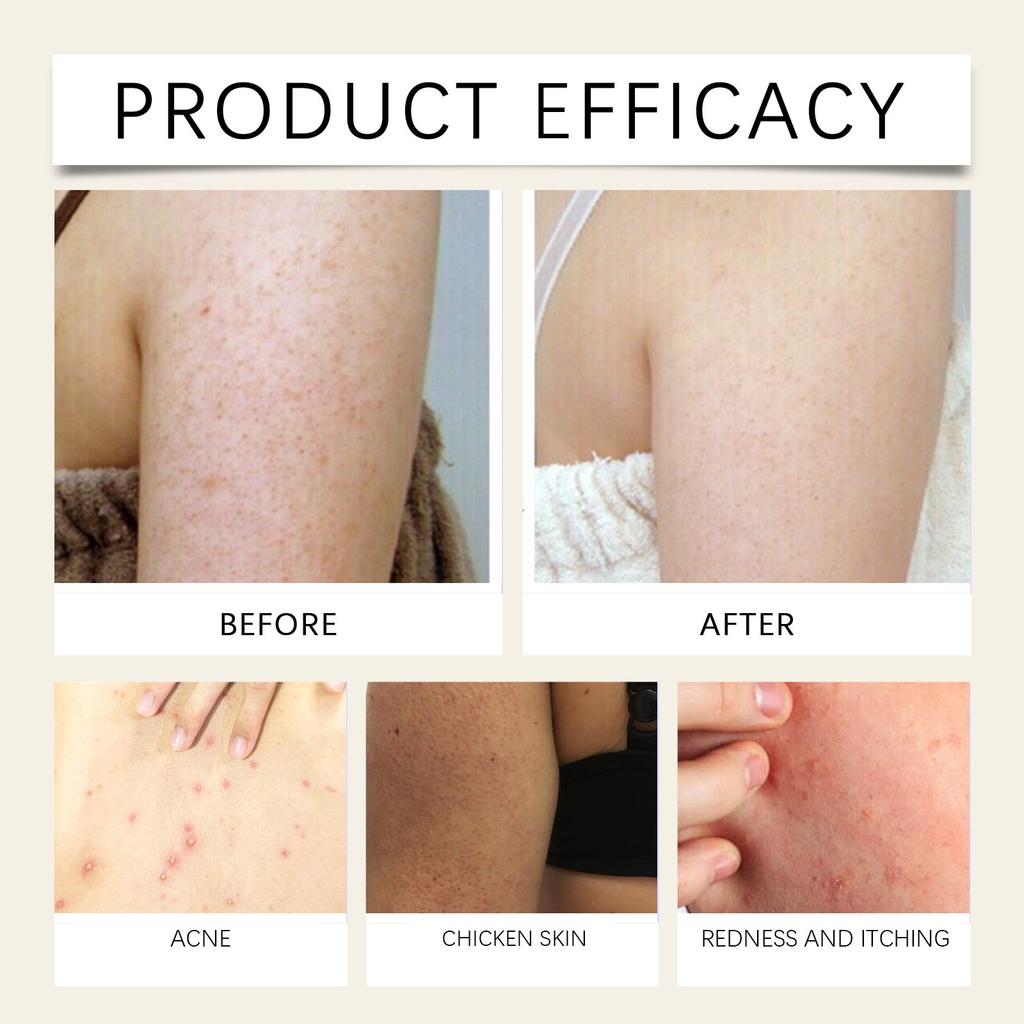 Успокаивающий спрей для кожи, Против акне, Снимает покраснение и зуд, Успокаивающая вода, Мягко успокаивает кожу без раздражения, 30 мл