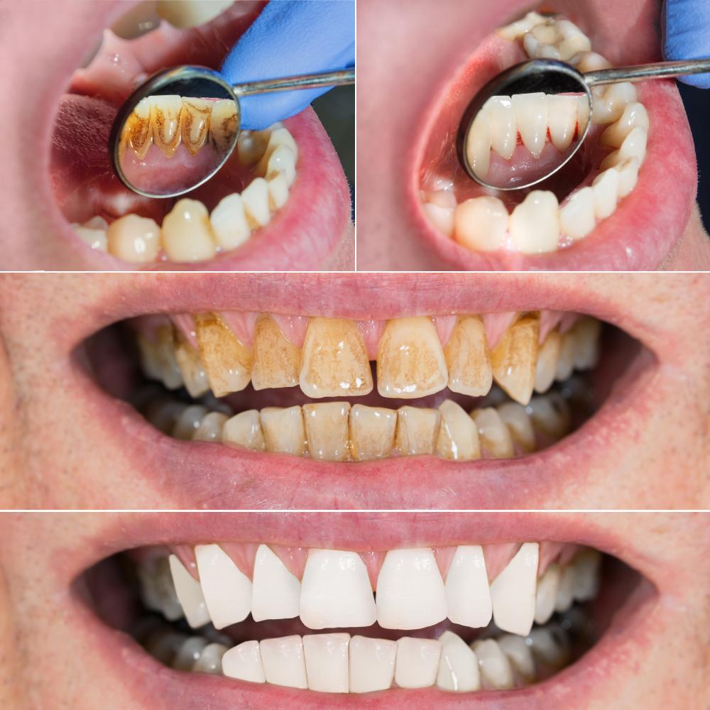 Ультразвуковой очиститель зубов Электрическая зубная щетка Устранитель зубного камня Скребок Очиститель Зубной скалер Устранитель зубного камня