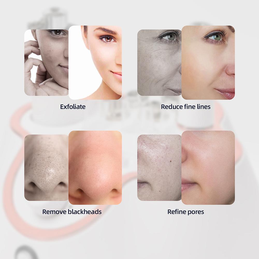 Foreverlily Алмазный пилинг для лица Машина для домашнего использования Профессиональная микродермабразия Нано спрей для воды Эксфолиация Косметологический аппарат