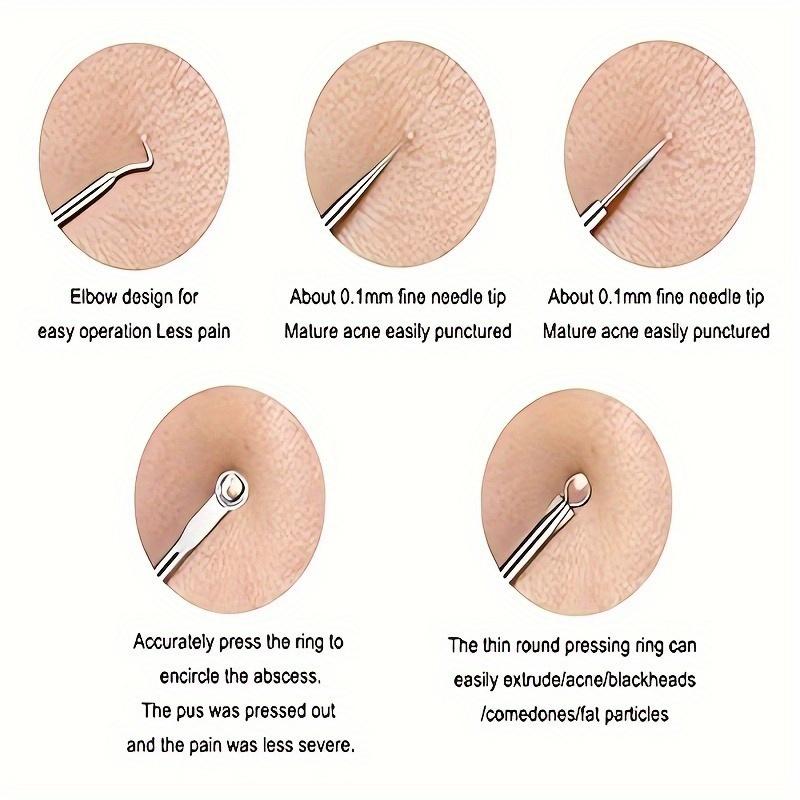 Набор игл для удаления угрей, инструмент для удаления черных точек, набор для удаления угрей, инструмент для удаления угрей на носу и лице с коробкой для устранения пятен