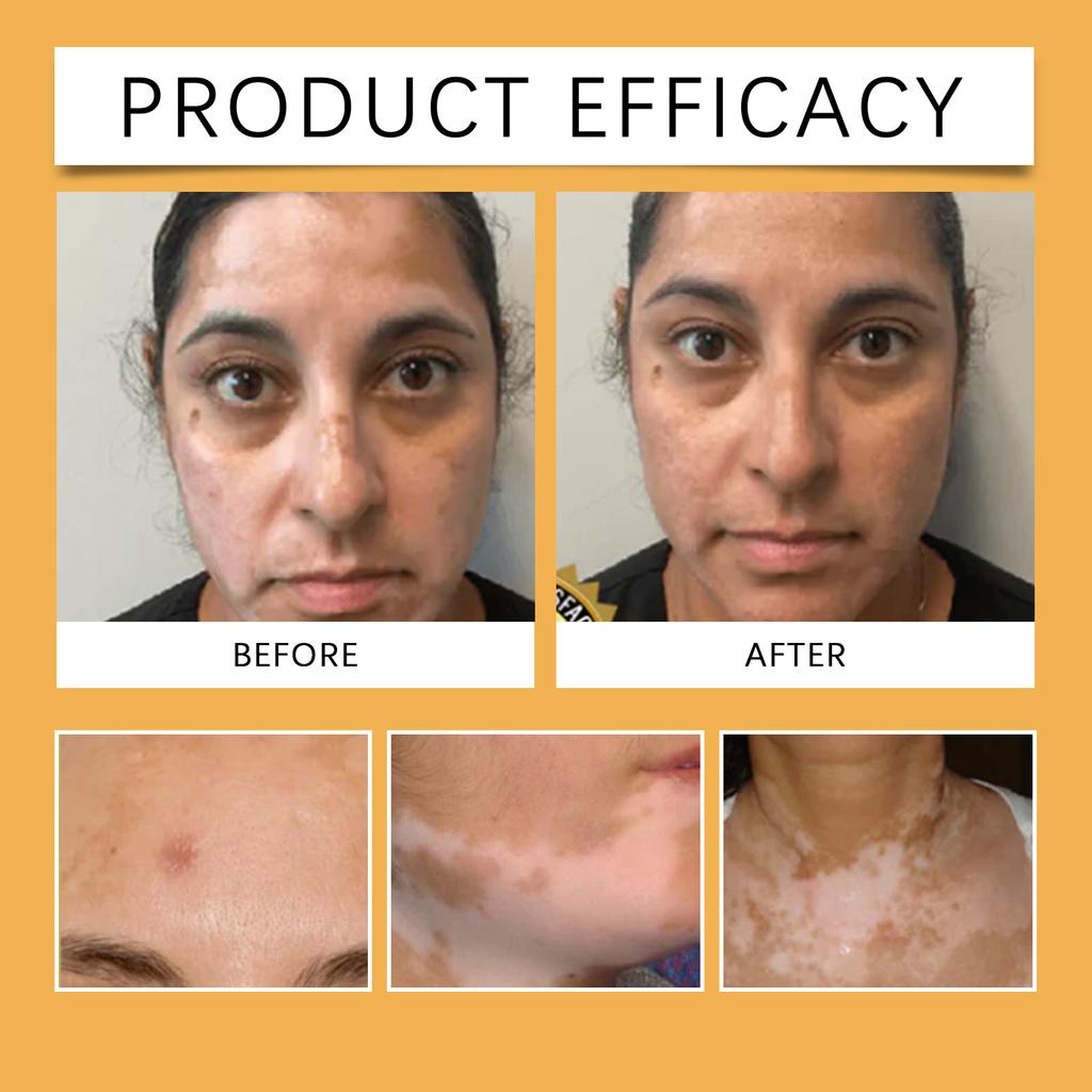 Крем для баланса кожи , Пигментация кожи , Витилиго , Уход за желтовато-коричневой кожей , Воспаление , Мягкая и увлажняющая текстура , Легкий и легко впитывающийся.