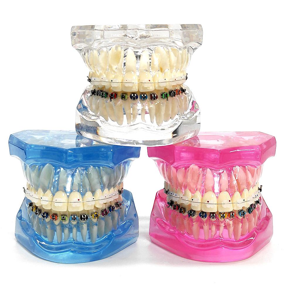 1 шт., стоматологическая ортодонтическая модель, связь с пациентом, 2 вида брекетов с дугами, лигатуры, керамический брекет, металлический краевой брекет