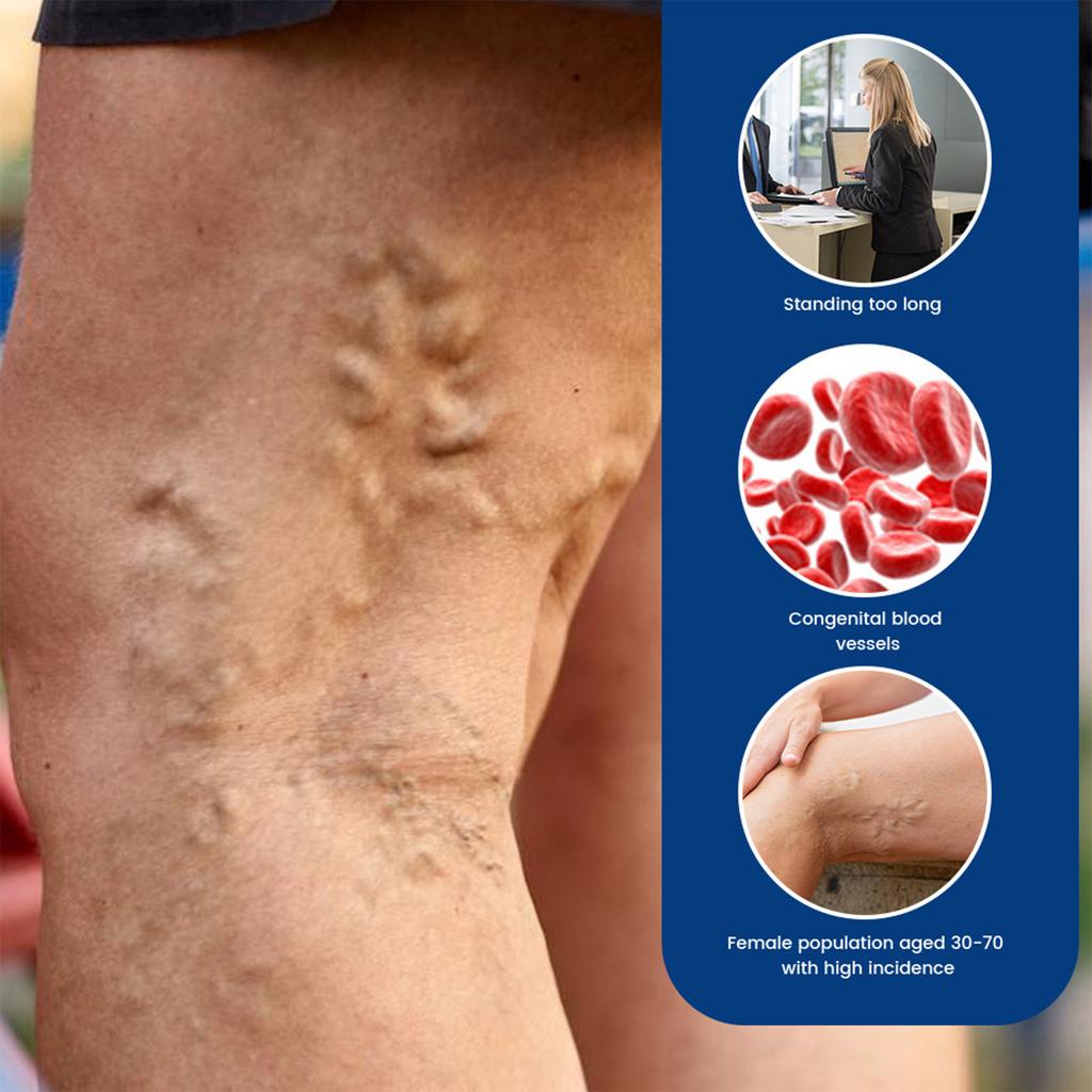 Vein Care Cream Mai Li Shu Ointment Earthworm Legs Spider Varicose Veins 20g