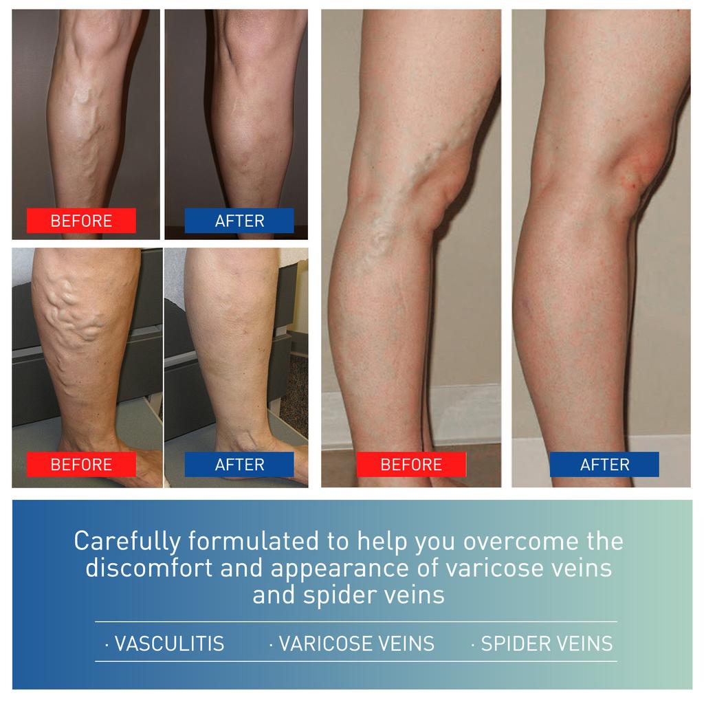 Varicose and Spider Veins Ease for Legs, Improve Blood Circulatio