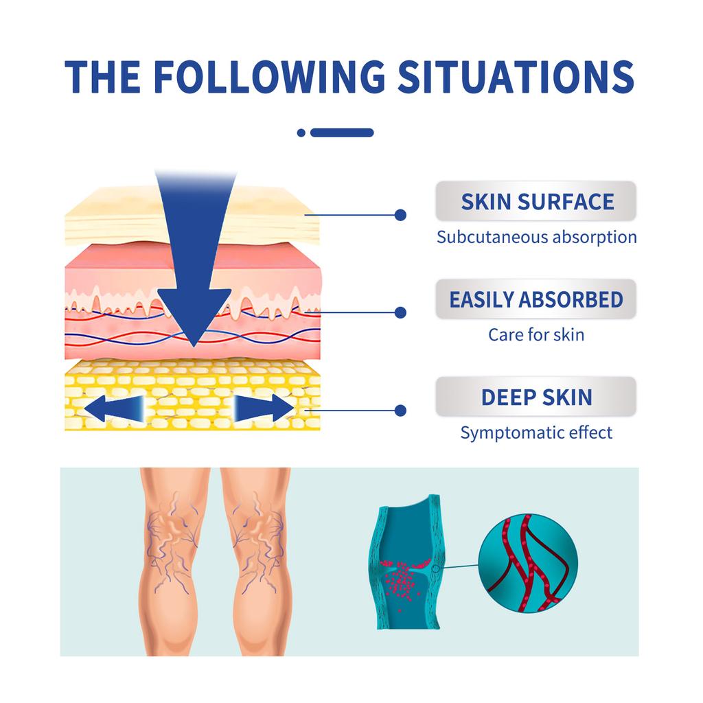 Паста Venoheal Vein Ease, паста для вен и сосудистых звездочек облегчает состояние ног, улучшает кровообращение
