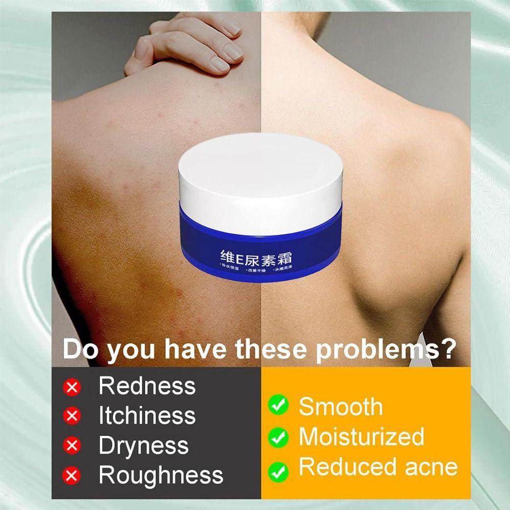 Отбеливающий крем для лица Удаление веснушек Увлажнитель для лица Крем для обесцвечивания кожи с мочевиной Уход за кожей