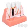 Модель зубов Анализ зубного имплантата Модель короночного моста Демонстрационная модель зуба