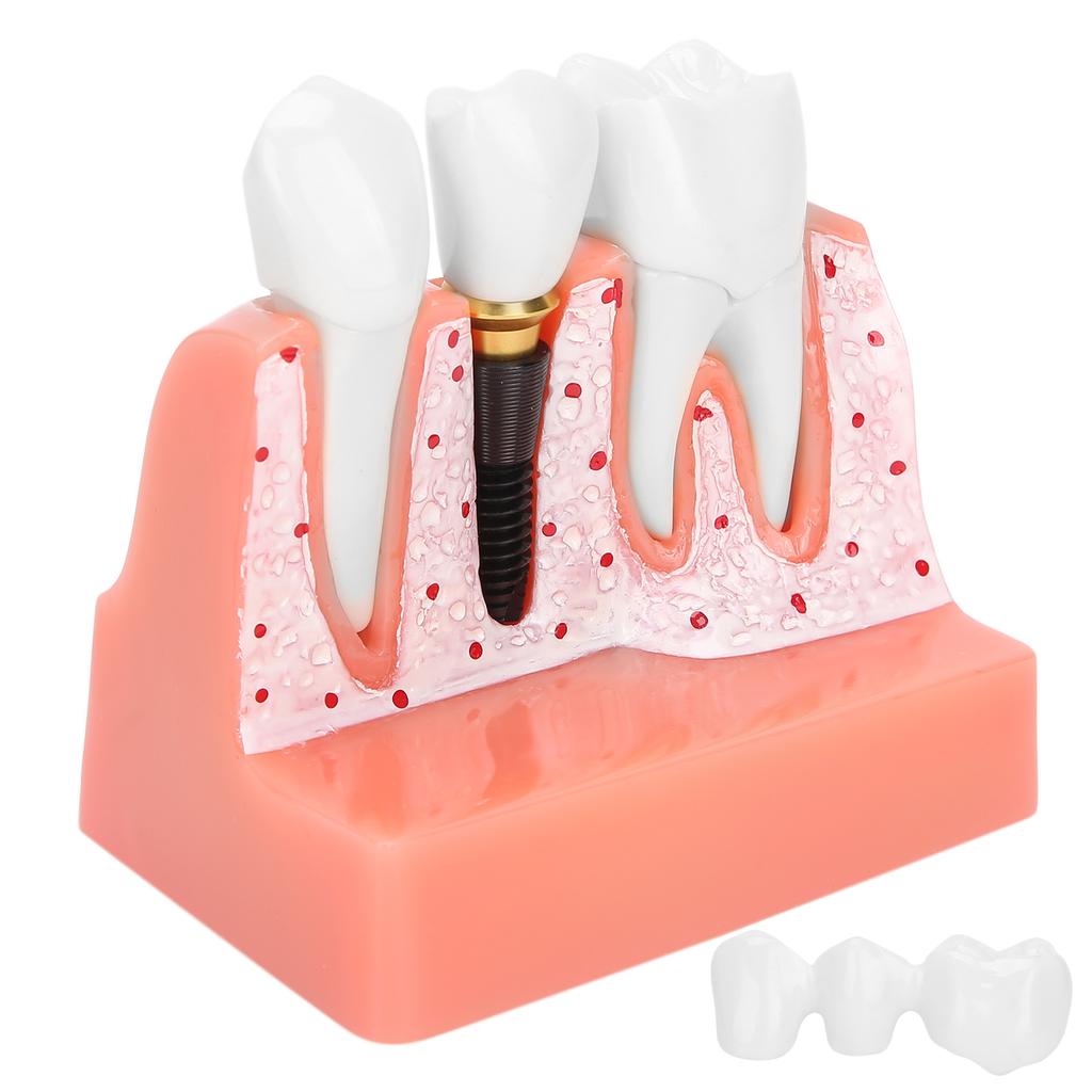 Модель зубов Анализ зубного имплантата Модель короночного моста Демонстрационная модель зуба