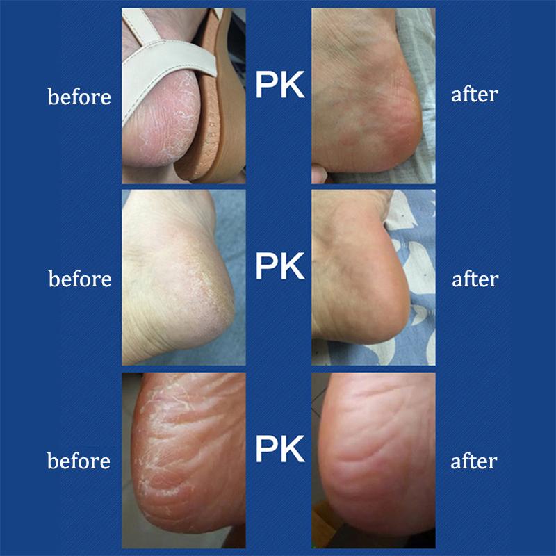 Электрическая шлифовальная машина для ног, артефакт для удаления омертвевшей кожи, USB-перезаряжаемый инструмент для ухода за ногами, бытовые инструменты для чистки трещин на ногах