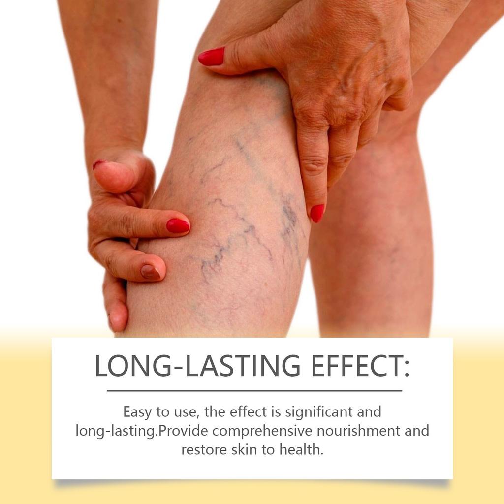 Уменьшите отек ног, дождевой червь, варикозное расширение вен, массаж вен, крем для ухода за телом
