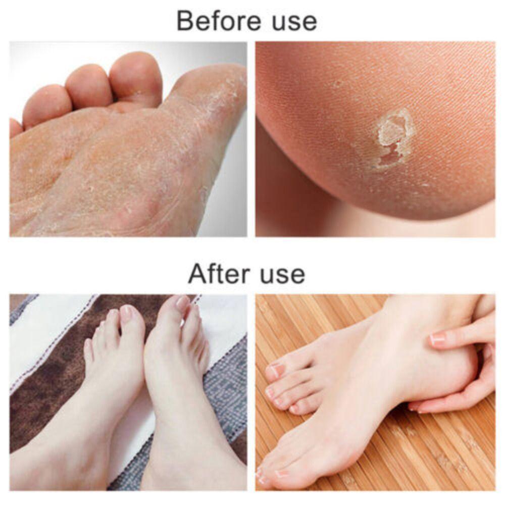 Dead Skin Remover Foot Sharpeners Pedicure Rasp Callus Remover Tool Foot Care Foot File Scraper