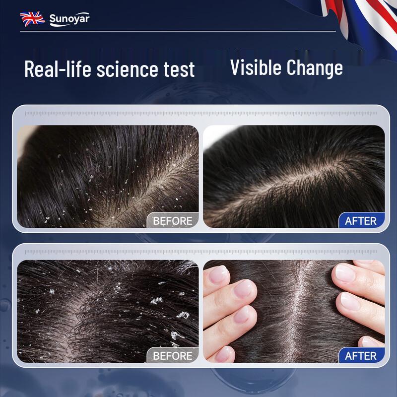 Sunoyar Folliculitis & Seborrheic Dermatitis Shampoo