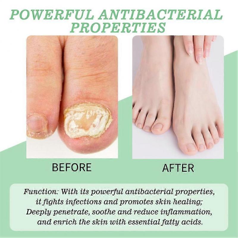 Nutraboost Nail Fungus Treatment Gel, 20ml Nutraboost Nail Gel, Natural Nail Repair Strengthening Gel Serum