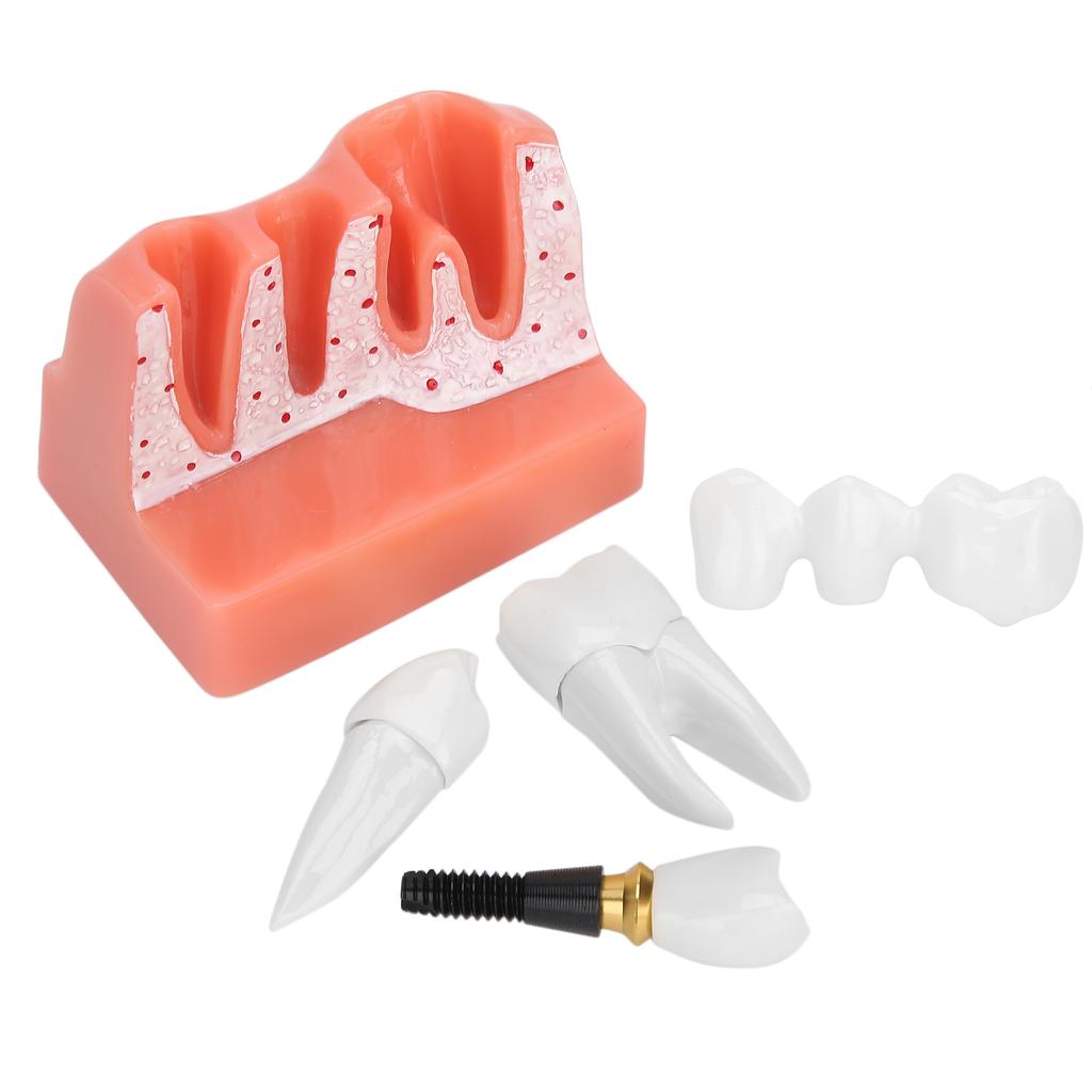 Модель зубов Анализ зубного имплантата Модель короночного моста Демонстрационная модель зуба
