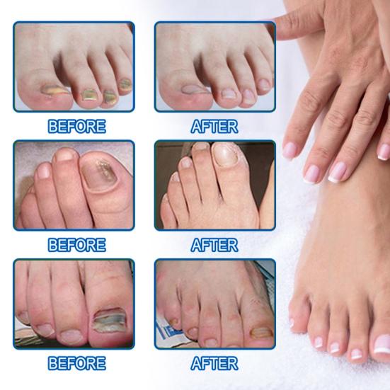 60Pcs/Box Nail Repair Patches Nail Repair Treatment Restores Damaged Nails and Appearance