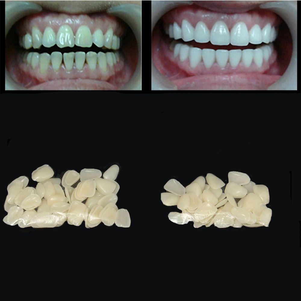 Beauty Veneers Ultra-Thin Whitening Upper Anterior Resin Teeth Dental Films Porcelain Teeth