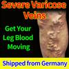 Product Targeted At Varicose Veins