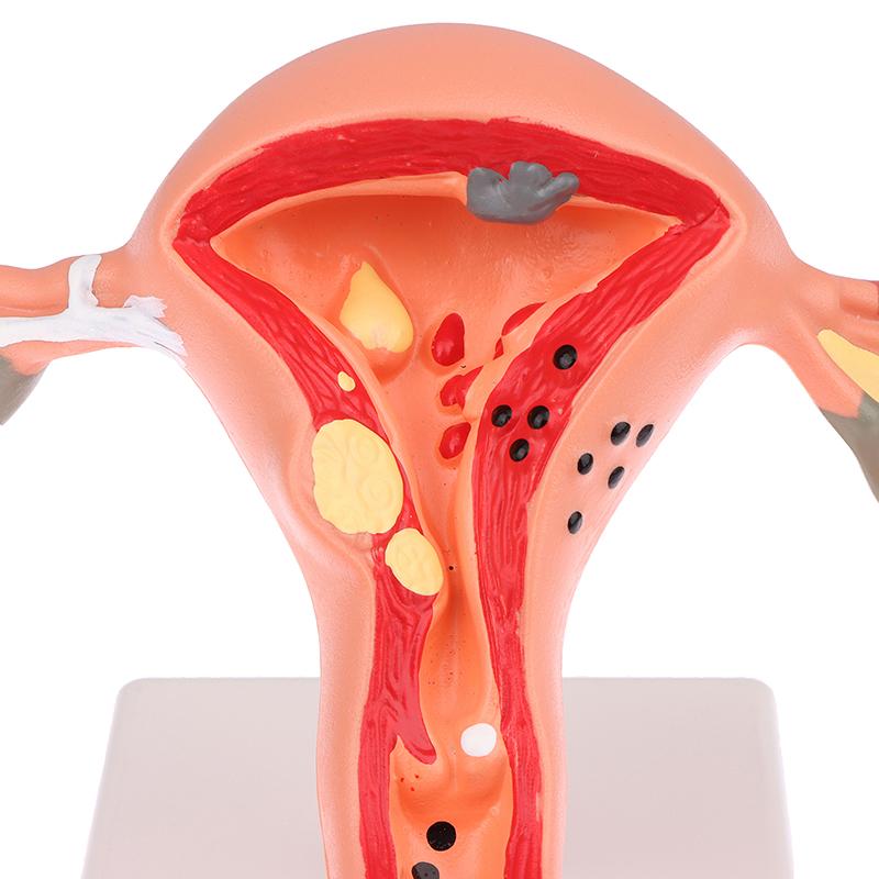 1 шт., медицинский реквизит, модель патологической матки, яичников, анатомическая модель, инструмент для изучения поперечного сечения анатомии