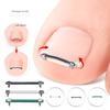 Инструмент для педикюра вросшего ногтя - Изогнутый зажим для ногтей на ногах, инструмент для ухода за ногтями на пальцах ног, выпрямляющая корректирующая клипса для пальцев ног - Инструмент для ухода за вросшим ногтем