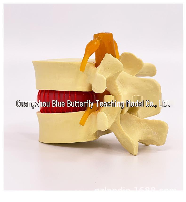 Подлинная модель протрузии поясничного отдела позвоночника и патологии позвонка