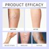 Varicose Veins Cream, Varicose Veins And Spider Veins Leg, Improve Blood Circulation, Fast-acting Relief Cream